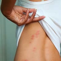 Rashes on the back of a woman