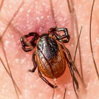 Tick embedded in someone's skin.