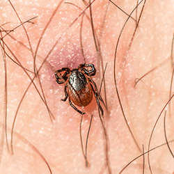 Tick embedded on a Springfield resident.