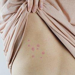 Bed bug bites on human skin.