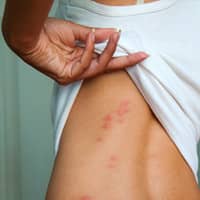 Rashes on the back of a woman