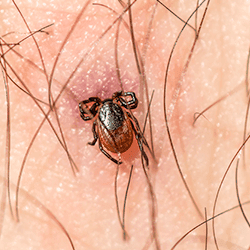 Tick embedded on a Springfield resident.