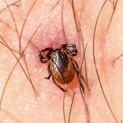 Tick embedded in someone's skin.